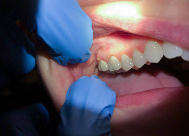 Best Urgent Care for Lost Fillings or Crowns in Sequim, WA